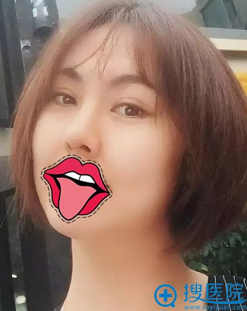 西安伊美尔王飞双眼皮和隆鼻案例 西安伊美尔王飞双眼皮和隆鼻案例