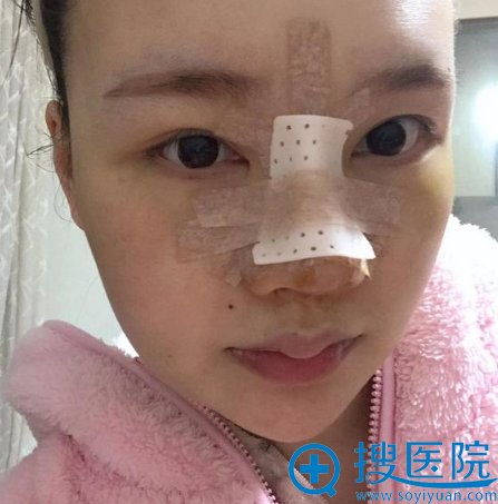 找上海薇琳医美顾陆健做完隆鼻三天图片 找上海薇琳医美顾陆健做完隆鼻三天图片