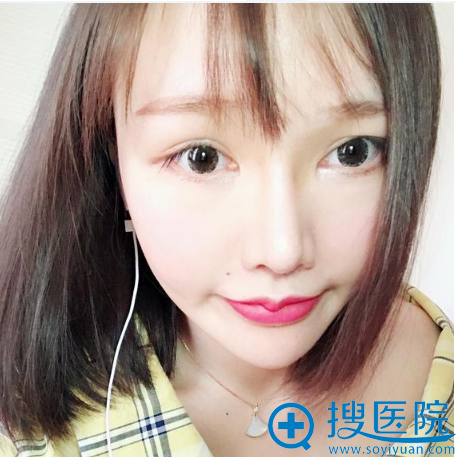 上海薇琳医美顾陆健隆鼻案例术后两个月图片 上海薇琳医美顾陆健隆鼻案例术后两个月图片