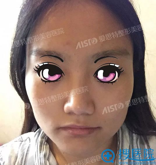 在重庆爱思特找高伟做改脸型前 在重庆爱思特找高伟做改脸型前