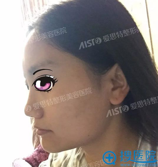 在重庆爱思特做颧骨下颌角手术前 在重庆爱思特做颧骨下颌角手术前