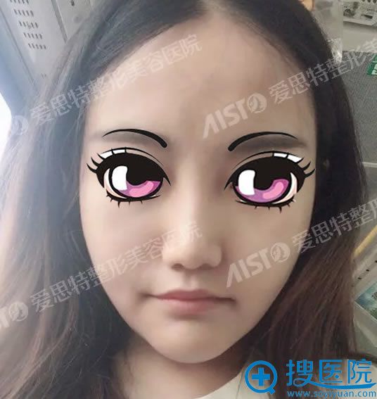 选择重庆爱思特高伟做下颌角16天后 选择重庆爱思特高伟做下颌角16天后