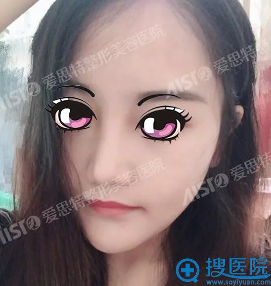 在重庆爱思特真伊做下颌角30天后 在重庆爱思特真伊做下颌角30天后