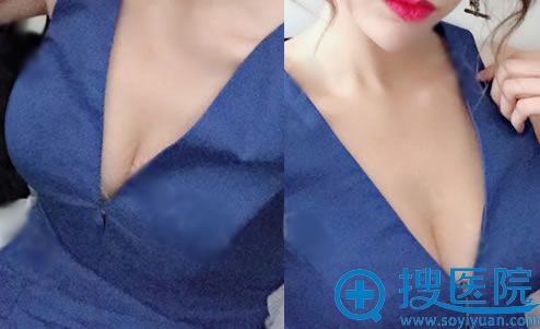 选择润美玉之光朱金成隆胸20天后 选择润美玉之光朱金成隆胸20天后