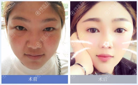 上海翡立思邵玉芳做的双眼皮案例 上海翡立思邵玉芳做的双眼皮案例