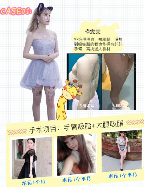 上海翡立思唐为东做的吸脂案例 上海翡立思唐为东做的吸脂案例