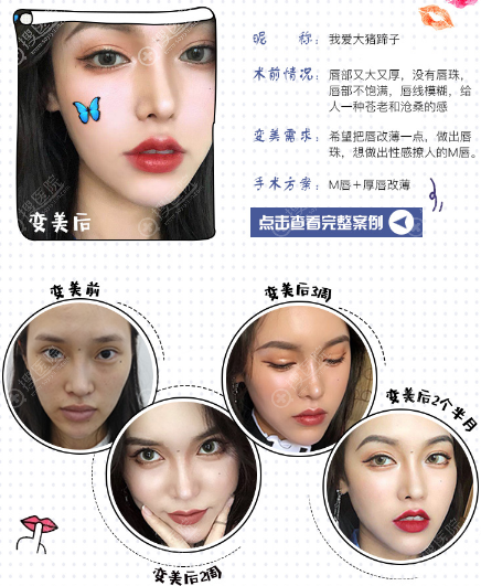 上海翡立思唐为东医生做的M唇手术 +厚唇改薄案例 上海翡立思唐为东医生做的M唇手术 +厚唇改薄案例