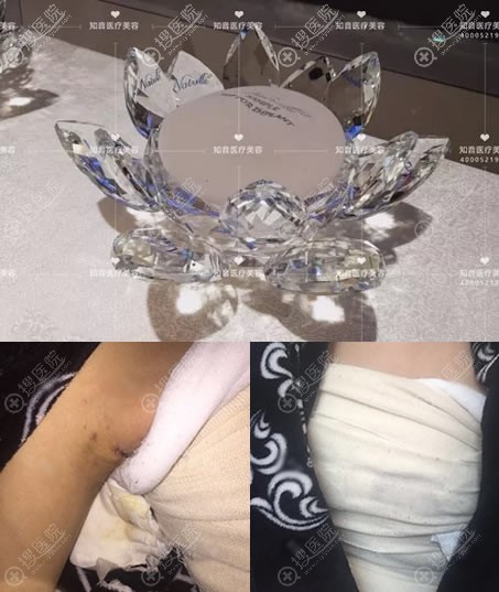 刚做完假体隆胸和植入的假体材料照片 刚做完假体隆胸和植入的假体材料照片