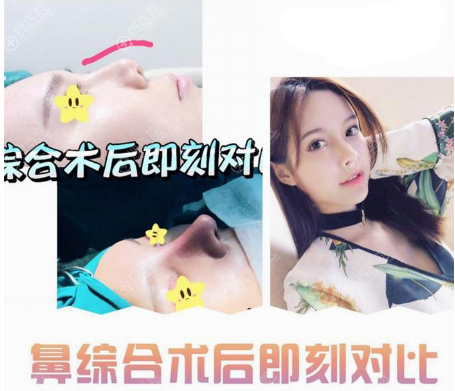 上海瑞欧陈超群做的隆鼻案例 上海瑞欧陈超群做的隆鼻案例