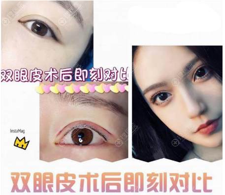 上海瑞欧网红院长陈超群做的双眼皮案例 上海瑞欧网红院长陈超群做的双眼皮案例