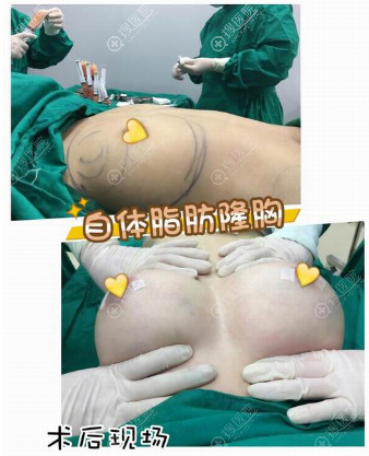 上海瑞欧网红院长陈超群做的隆胸案例 上海瑞欧网红院长陈超群做的隆胸案例