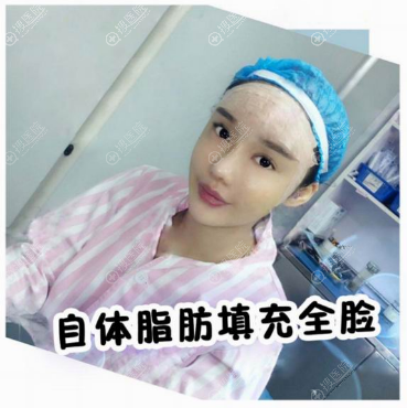 上海瑞欧陈超群做的自体脂肪面部填充案例 上海瑞欧陈超群做的自体脂肪面部填充案例