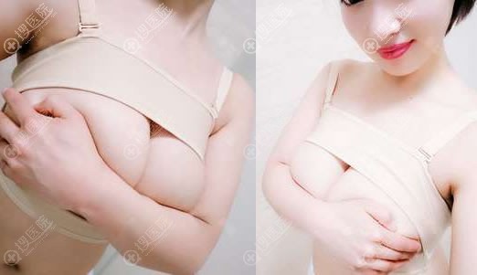 做完假体隆胸14天恢复照 做完假体隆胸14天恢复照