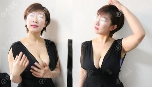 北京长虹赵宏伟假体隆胸案例半年效果 北京长虹赵宏伟假体隆胸案例半年效果