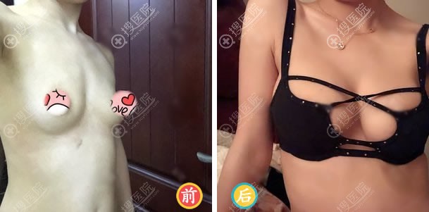 成都瑞美荟薛瑞假体隆胸案例 成都瑞美荟薛瑞假体隆胸案例