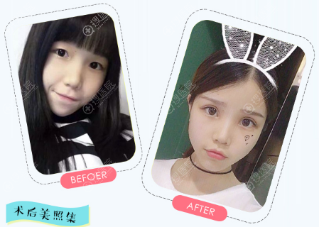 上海丽质卢九宁双眼皮案例 上海丽质卢九宁双眼皮案例