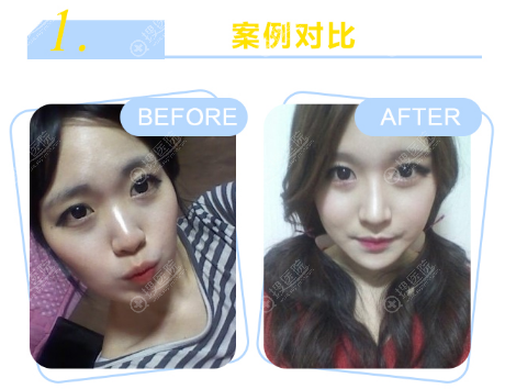 上海丽质卢九宁隆鼻案例 上海丽质卢九宁隆鼻案例