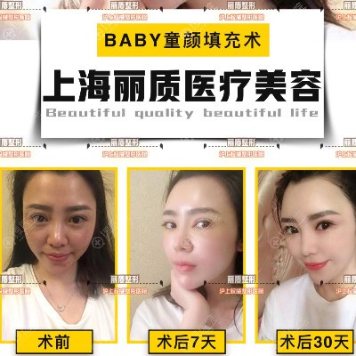上海丽质陈新平做的自体脂肪面部填充案例 上海丽质陈新平做的自体脂肪面部填充案例