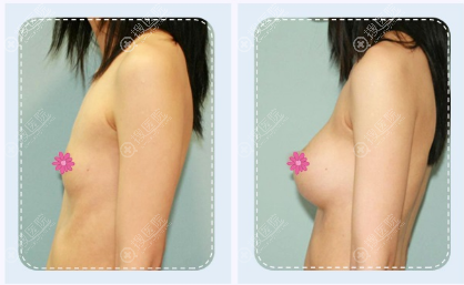 上海丽质卢九宁隆胸案例 上海丽质卢九宁隆胸案例