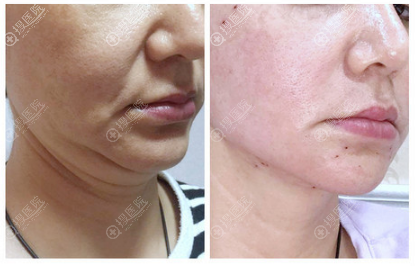 上海丽质卢九宁线雕埋线提升案例 上海丽质卢九宁线雕埋线提升案例