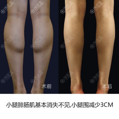 上海丽质卢九宁吸脂瘦腿案例 上海丽质卢九宁吸脂瘦腿案例