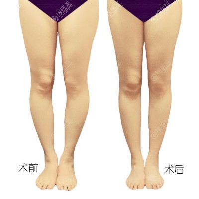 上海丽质卢九宁O型腿形体矫正案例 上海丽质卢九宁O型腿形体矫正案例