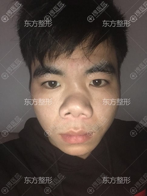 南宁东方整形歪鼻矫正手术对象 南宁东方整形歪鼻矫正手术对象