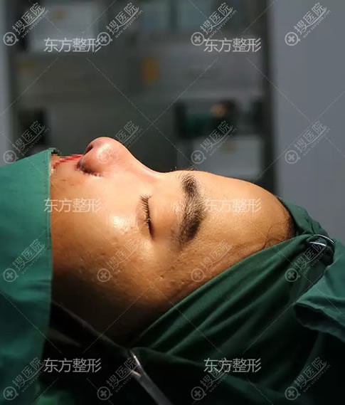 南宁东方整形歪鼻矫正即刻效果 南宁东方整形歪鼻矫正即刻效果