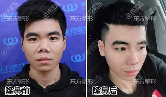 南宁东方龙海波歪鼻矫正案例对比图 南宁东方龙海波歪鼻矫正案例对比图