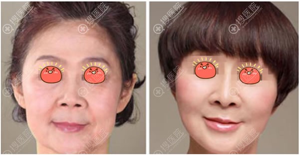 北京壹加壹面部拉皮手术案例 北京壹加壹面部拉皮手术案例