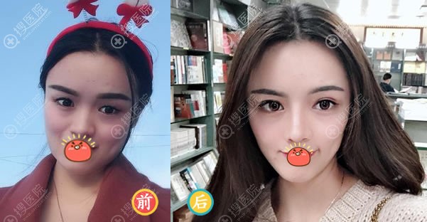 北京壹加壹张绿峰隆鼻案例 北京壹加壹张绿峰隆鼻案例