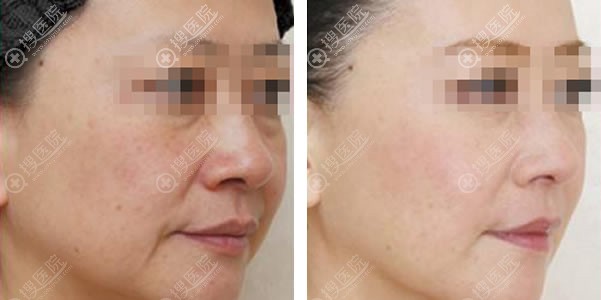 北京壹加壹李凤苔除皱案例 北京壹加壹李凤苔除皱案例