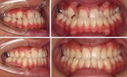 北京壹加壹张莹牙齿矫正案例 北京壹加壹张莹牙齿矫正案例