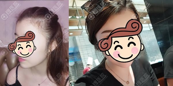 北京壹加壹医疗美容郝文义植发案例 北京壹加壹医疗美容郝文义植发案例