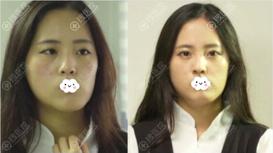 手术前鼻梁塌鼻子歪 手术前鼻梁塌鼻子歪