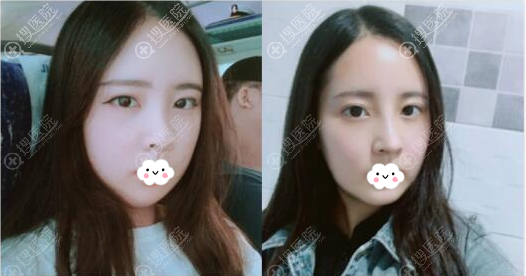 李炳浍耳软骨复合隆鼻术后一周 李炳浍耳软骨复合隆鼻术后一周