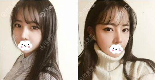 深圳回来李炳浍歪鼻矫正术后2个月 深圳回来李炳浍歪鼻矫正术后2个月