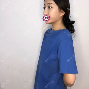 广东画美隆胸前 广东画美隆胸前