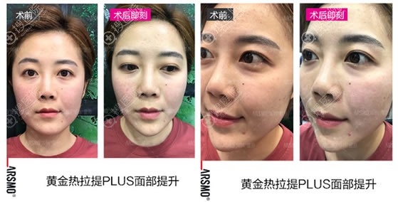 北京华韩黄金热拉提PLUS案例效果 北京华韩黄金热拉提PLUS案例效果