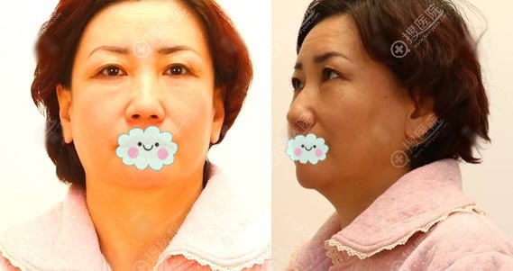 在华韩做面部提升手术前 在华韩做面部提升手术前