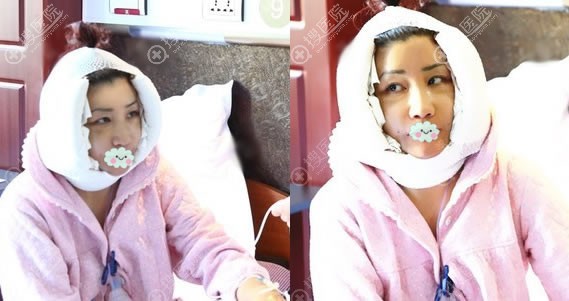 刚做完面部拉皮除皱提升术图片 刚做完面部拉皮除皱提升术图片