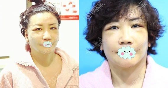 做完拉皮手术不戴头套的照片 做完拉皮手术不戴头套的照片