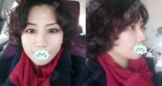 北京华韩面部拉皮提升手术案例 北京华韩面部拉皮提升手术案例