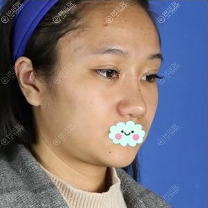 做面部线雕提升术前 做面部线雕提升术前