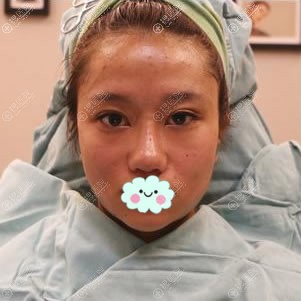 刚做完面部线雕提升的效果图片 刚做完面部线雕提升的效果图片