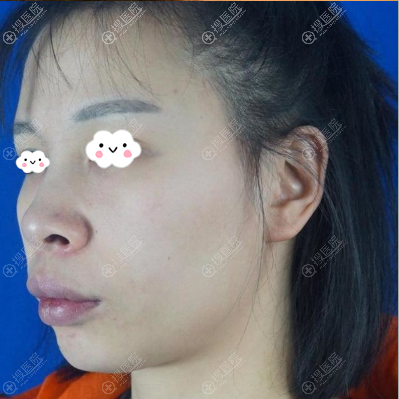 术前牙齿不暴但是突嘴 术前牙齿不暴但是突嘴