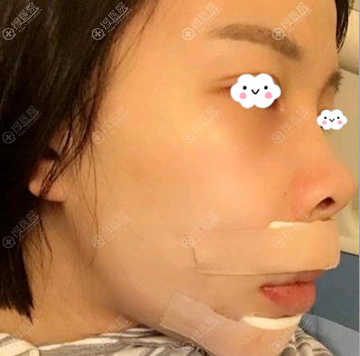 正颌手术术后3天恢复图片 正颌手术术后3天恢复图片