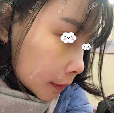 重庆爱思特双颚手术后恢复效果 重庆爱思特双颚手术后恢复效果