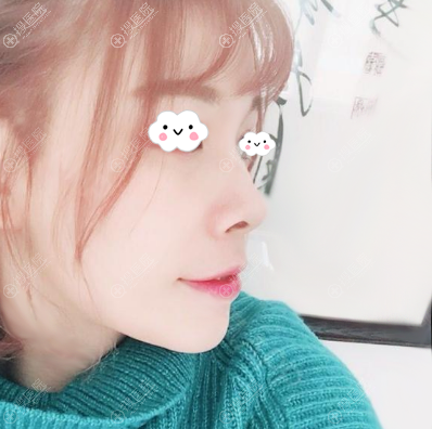 重庆爱思特王涛正颌手术术后效果图 重庆爱思特王涛正颌手术术后效果图