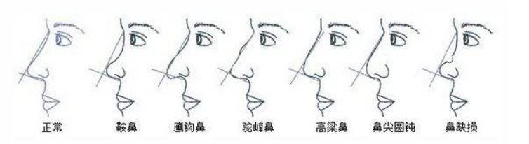 需要做隆鼻整形的鼻型示意图 需要做隆鼻整形的鼻型示意图